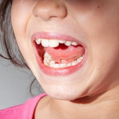Misaligned Teeth