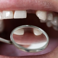 Missing Teeth